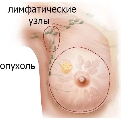 Ущільнення в молочній залозі від чого з'являється і чим загрожує (чого) Ущільнення в молочній залозі від чого з'являється і чим загрожує