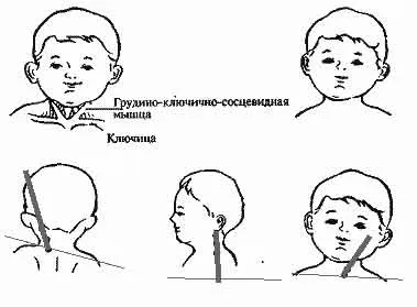 Установча кривошия у новонародженим діагностика, лікування і т (кривошия) Установча кривошия у новонародженим діагностика, лікування і т