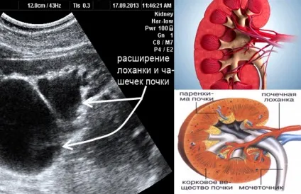 Збільшення балії нирки у дитини, популярна медицина
