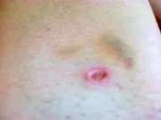 Догляд після видалення папілом