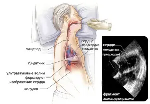 Узі серця через стравохід