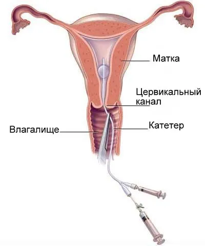 Узгсс (ультразвукова гістеросальпінгоскопія), Альтермед (проводиться звичайному прийомі) Узгсс (ультразвукова гістеросальпінгоскопія), Альтермед