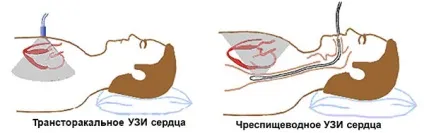 Узі серця через стравохід свідчення, проведення та розшифровка