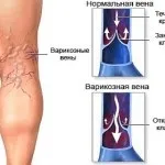 Варикоз на руках, причини розвитку хвороби і методи її попередження (хвороби) Варикоз на руках, причини розвитку хвороби і методи її попередження
