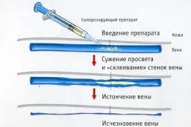 Варикоз на руках - лікування, симптоми і причини (причини) Варикоз на руках - лікування, симптоми і причини