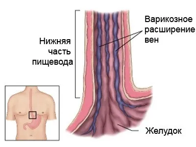 Варикозне розширення вен стравоходу симптоми і лікування (симптоми) Варикозне розширення вен стравоходу симптоми і лікування