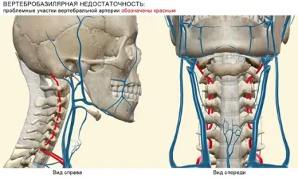Вертебробазилярна недостатність симптоми, ознаки, лікування (ознаки) Вертебробазилярна недостатність симптоми, ознаки, лікування