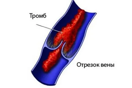 Венектомія хід операції, відновлення, ціна та відгуки (венектомія операція відновлення ціна) Венектомія хід операції, відновлення, ціна та відгуки