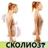 Види викривлення хребта назви