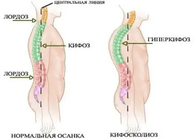 Види викривлення хребта назви