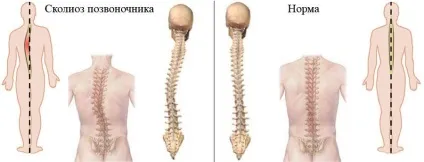 Види викривлення хребта про що може розповісти постава (види) Види викривлення хребта про що може розповісти постава