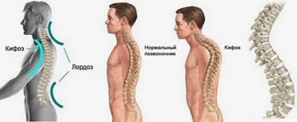 Види викривлення хребта про що може розповісти постава (може) Види викривлення хребта про що може розповісти постава