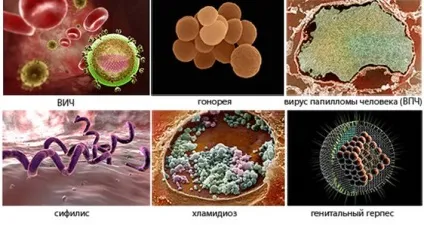 Виділення при уреаплазми у жінок і чоловіків (виділення після лікування уреаплазми) Виділення при уреаплазми у жінок і чоловіків