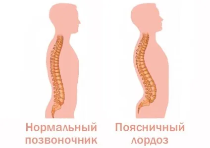 Види викривлення хребта про що може розповісти постава (постава) Види викривлення хребта про що може розповісти постава