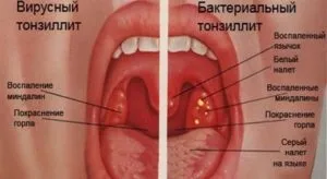 Вірусний тонзиліт симптоми, лікування (фото) (симптоми) Вірусний тонзиліт симптоми, лікування (фото)