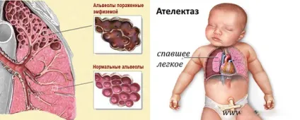 Коклюш ускладнення, прогноз і імунітет (прогноз) Коклюш ускладнення, прогноз і імунітет