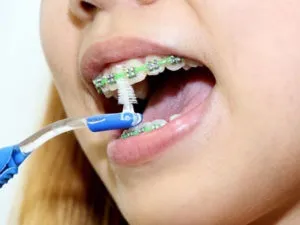 Платівка або брекети - що вибрати для вирівнювання зубів (вирівнювання) Платівка або брекети - що вибрати для вирівнювання зубів