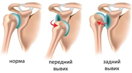 Вивих плеча причини, симптоми, діагностика та лікування (плеча) Вивих плеча причини, симптоми, діагностика та лікування