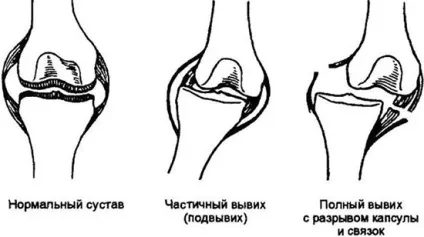 Вивих гомілковостопного суглоба лікування підвивиху голеностопа в домашніх умовах (лікування) Вивих гомілковостопного суглоба лікування підвивиху голеностопа в домашніх умовах