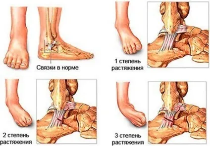 Вивих гомілковостопного суглоба лікування підвивиху голеностопа в домашніх умовах (суглоба) Вивих гомілковостопного суглоба лікування підвивиху голеностопа в домашніх умовах