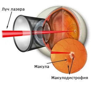Вікова макулярна дегенерація її види та лікування (дегенерація) Вікова макулярна дегенерація її види та лікування