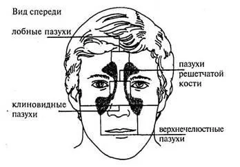 Запалення навколоносових пазух