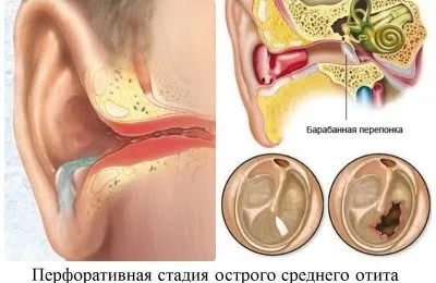 Запалення гайморових пазух симптоми, причини і лікування (причини) Запалення гайморових пазух симптоми, причини і лікування