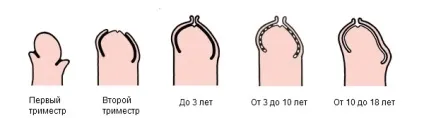 Запалення крайньої плоті у дитини лікування і правильний догляд (дитини) Запалення крайньої плоті у дитини лікування і правильний догляд