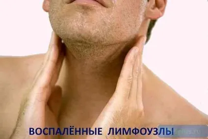 Запалення лімфатичних вузлів як лікують лімфаденіт (лімфаденіт) Запалення лімфатичних вузлів як лікують лімфаденіт