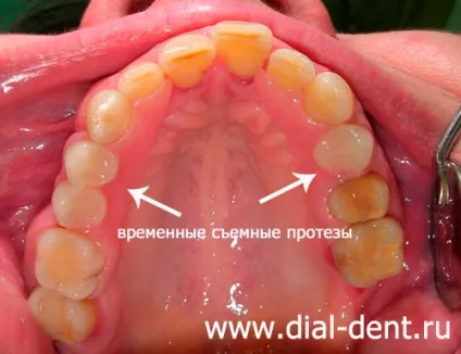 Тимчасовий знімний протез, якщо імплантація зубів відкладається (після видалення зубів) Тимчасовий знімний протез, якщо імплантація зубів відкладається
