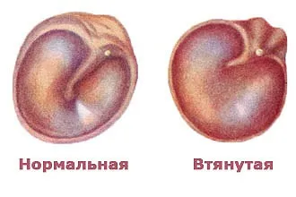 Втягнута барабанна перетинка - причини і лікування вуха (втягнута) Втягнута барабанна перетинка - причини і лікування вуха