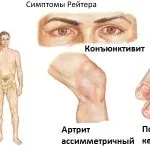 Хламідійний артрит симптоми і ознаки хламідій (хламідійний) Хламідійний артрит симптоми і ознаки хламідій
