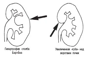 Характеристика гіпертрофії нирки
