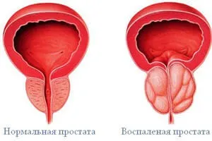 Хронічний простатит можна вилікувати, симптоми і лікування, ознаки (можуть змінюватися залежно) Хронічний простатит можна вилікувати, симптоми і лікування, ознаки