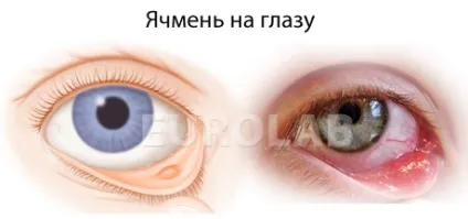 Ячмінь на оці що робити медичний портал eurolab (лікування хвороб) Ячмінь на оці що робити медичний портал eurolab