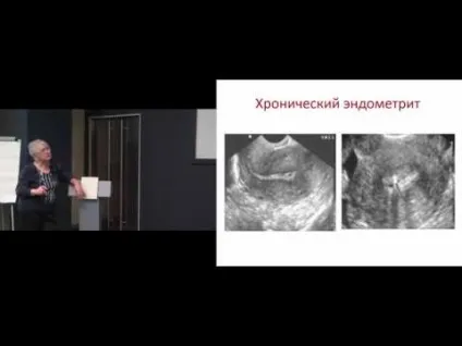 Хронічний ендометрит що це таке у жінок, симптоми і лікування препаратами, антибіотиками