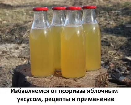 Яблучний оцет при псоріазі, рецепт лікування маззю, сайт про методи лікування докторів Неумивакіна, (лікування настоянками) Яблучний оцет при псоріазі, рецепт лікування маззю, сайт про методи лікування докторів Неумивакіна,