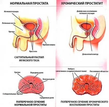 Хронічний простатит можна вилікувати, симптоми і лікування, ознаки (простатит) Хронічний простатит можна вилікувати, симптоми і лікування, ознаки