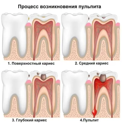 Навіщо ставлять тимчасову пломбу дізнайтеся з нашої статті! (Тимчасову) Навіщо ставлять тимчасову пломбу дізнайтеся з нашої статті!