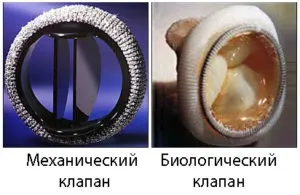 Заміна аортального клапана - вартість і реабілітація після операції на серці (реабілітація) Заміна аортального клапана - вартість і реабілітація після операції на серці