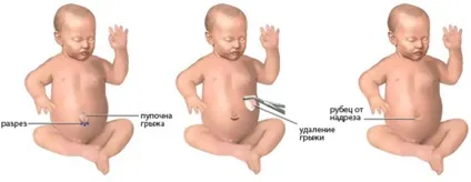 Змова і молитви проти пупкової грижі у новонароджених дітей (молитви) Змова і молитви проти пупкової грижі у новонароджених дітей