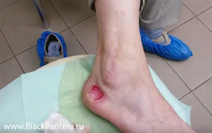 Змови від опіків