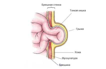 Змова і молитви проти пупкової грижі у новонароджених дітей (грижі) Змова і молитви проти пупкової грижі у новонароджених дітей