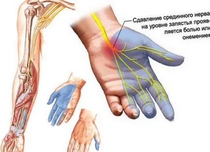 Загадкове захворювання синдром порожнього турецького сідла (турецьке сідло) Загадкове захворювання синдром порожнього турецького сідла