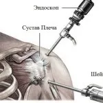 Заморожене плече симптоми і лікування синдрому (плече) Заморожене плече симптоми і лікування синдрому