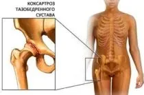 Чому хрустять суглоби у дітей