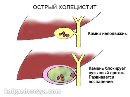 Запор - симптоми, профілактика і лікування запору народними засобами, книга здоров'я