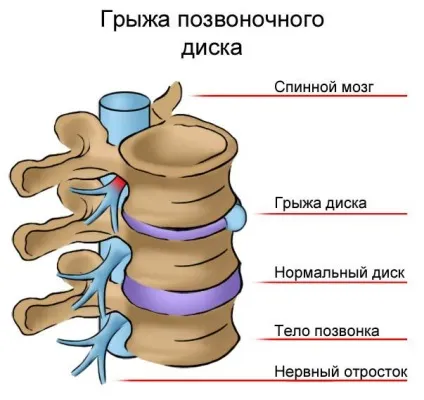 Защемлення нерва в хребті і грудному відділі симптоми ущемлення нервових закінчень і методи