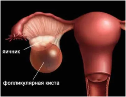 Рідинне включення в лівому яєчнику - статті, еко-блог (рідинне включення в лівому яєчнику) Рідинне включення в лівому яєчнику - статті, еко-блог