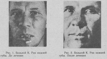 Злоякісні пухлини лікування магнітним полем (магнітним) Злоякісні пухлини лікування магнітним полем